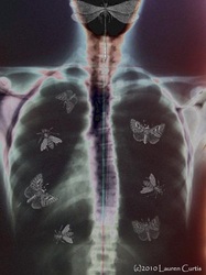 Chest x-ray collaged with  Victorian woodcuts of moths & butterflies in the lungs and a dragonfly in the head area.  Dark tones.